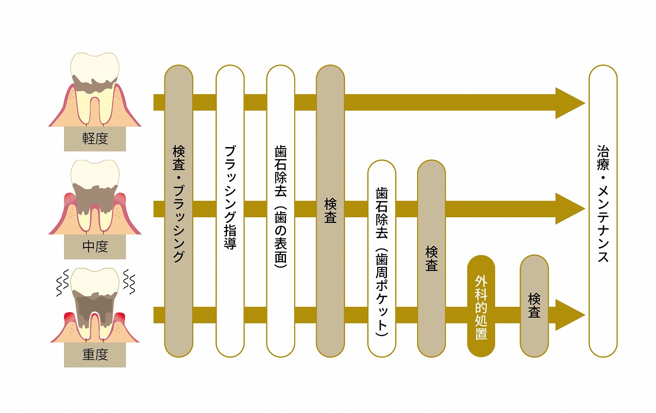 歯周病治療のながれ